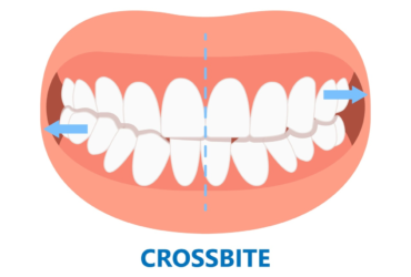 Close-up of a crossbite, where upper teeth sit inside lower teeth.