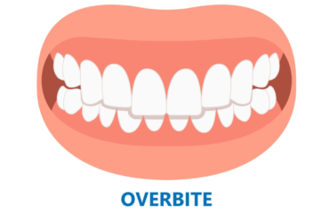 Close-up of an overbite with upper teeth overlapping lower teeth.