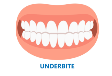 Close-up of an underbite, where the lower teeth extend beyond the upper teeth.