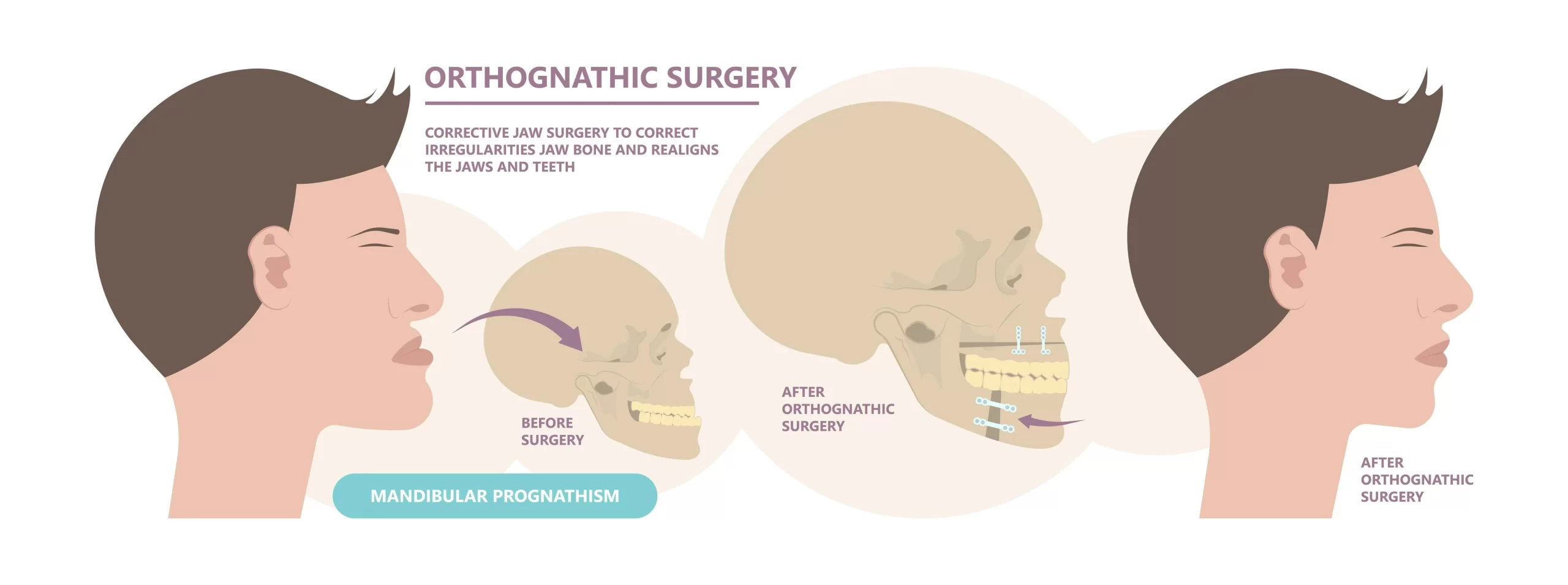 Orthodontist explaining orthognathic surgery to correct jaw misalignment.