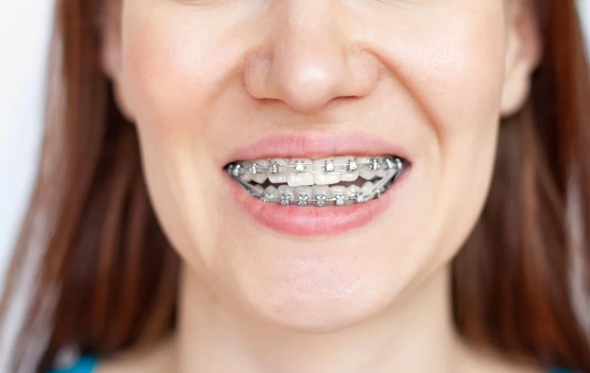 5 Reasons Why Adult Braces Are Worth It