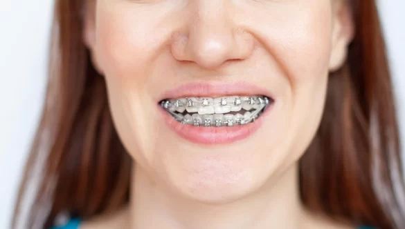 5 Reasons Why Adult Braces Are Worth It