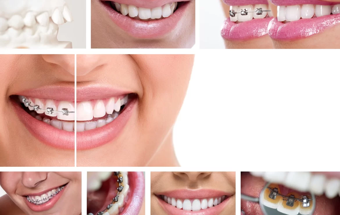 How Long Does Braces Treatment Take? Insights and Tips