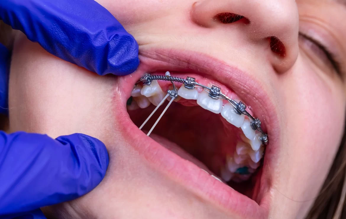 The Essential Guide to Braces and Rubber Bands: What You Need to Know