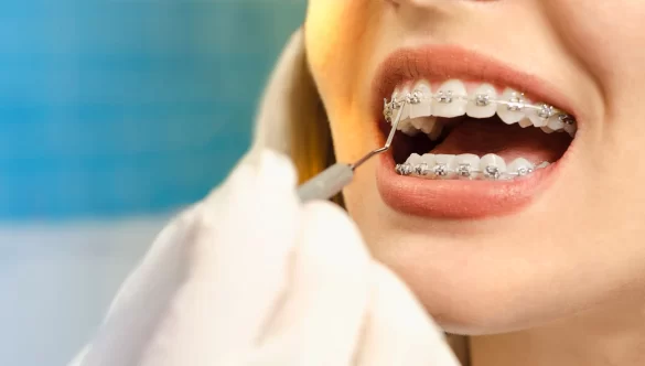 What to Do If a Bracket Comes Loose on Your Braces