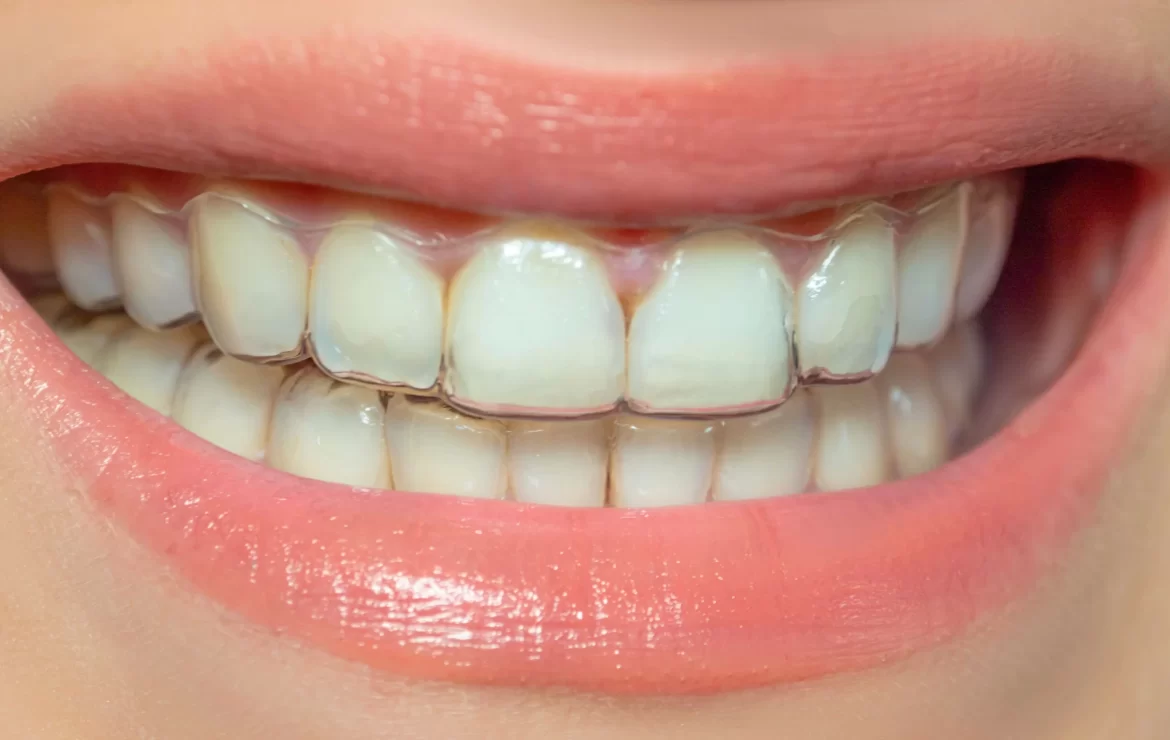 How Much Does Clear Aligner Treatment Cost Without Insurance?