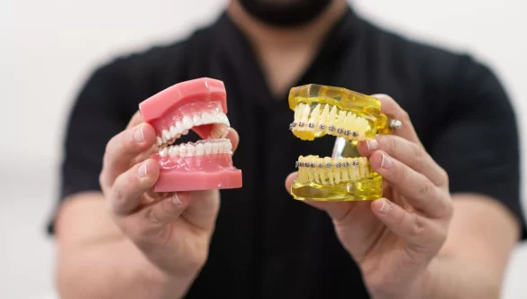 A Comprehensive Overview of Braces Options