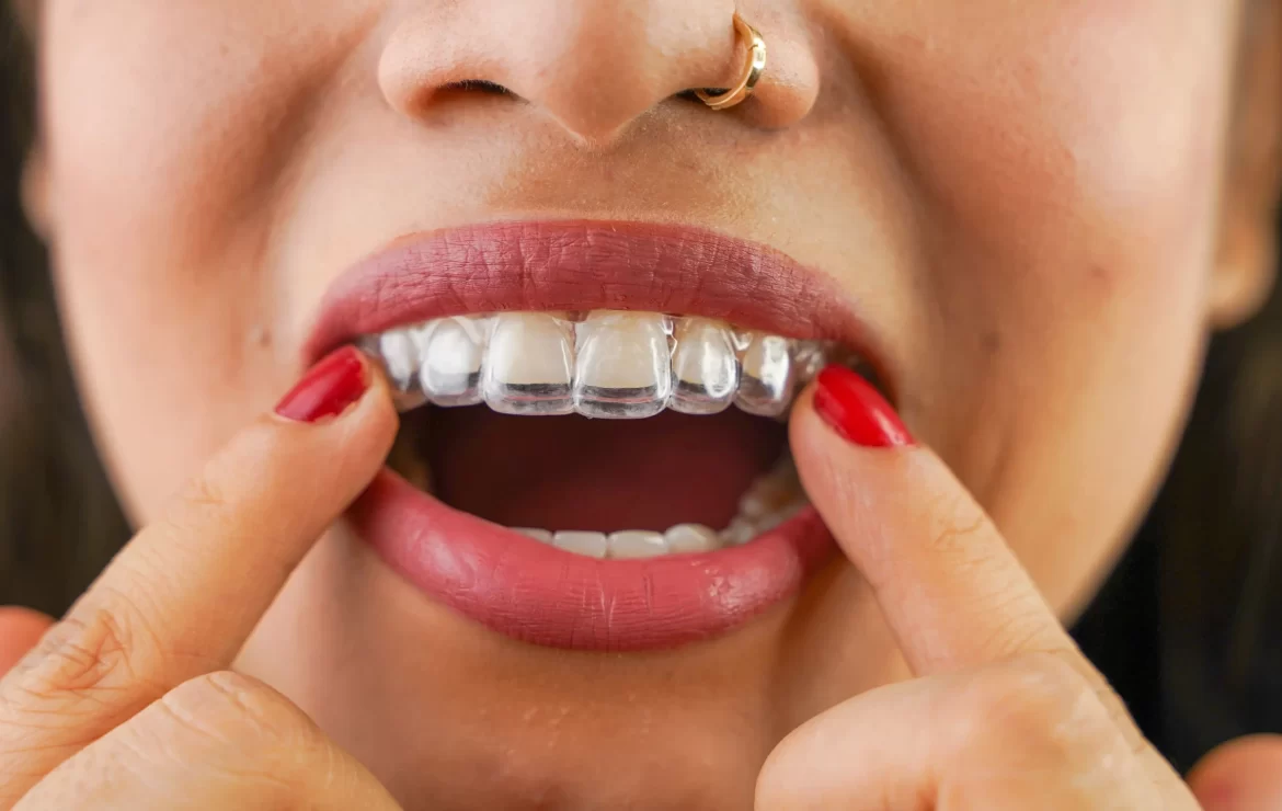 What to Do if You Haven’t Been Wearing Your Clear Aligners