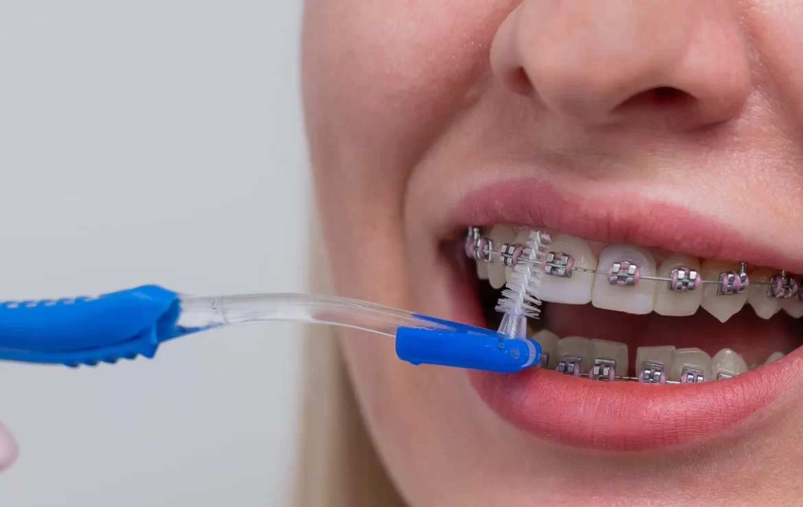 How to Clean Braces: Effective Methods