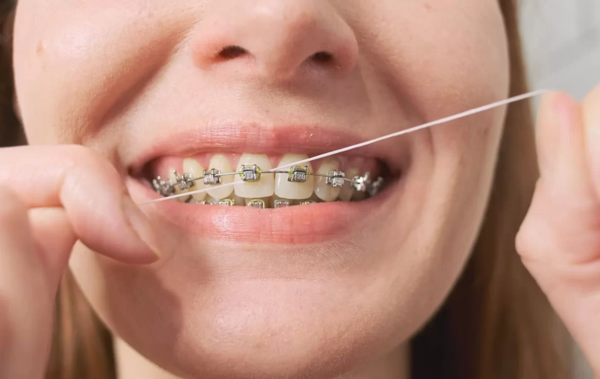 Mastering Flossing Techniques with Braces