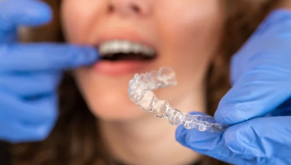 How to Minimize Discomfort with Clear Aligners