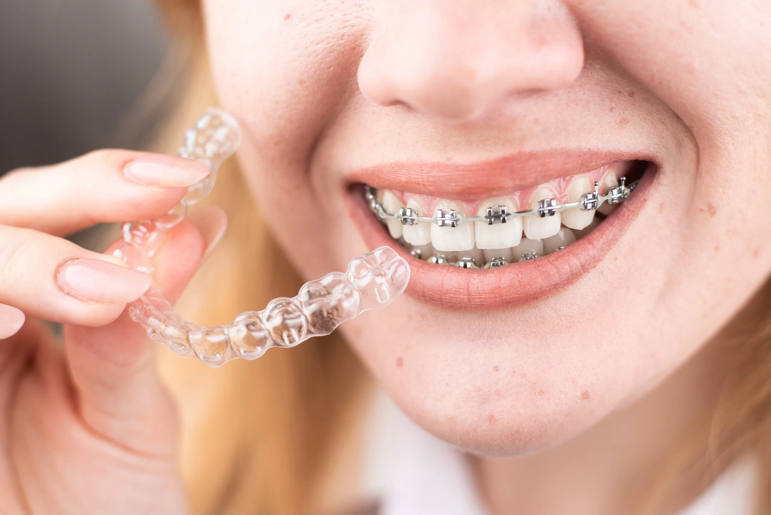 Women wearing braces and holding clear aligners