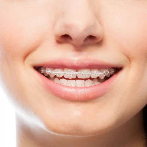 Close-up of smiles with clear braces results.