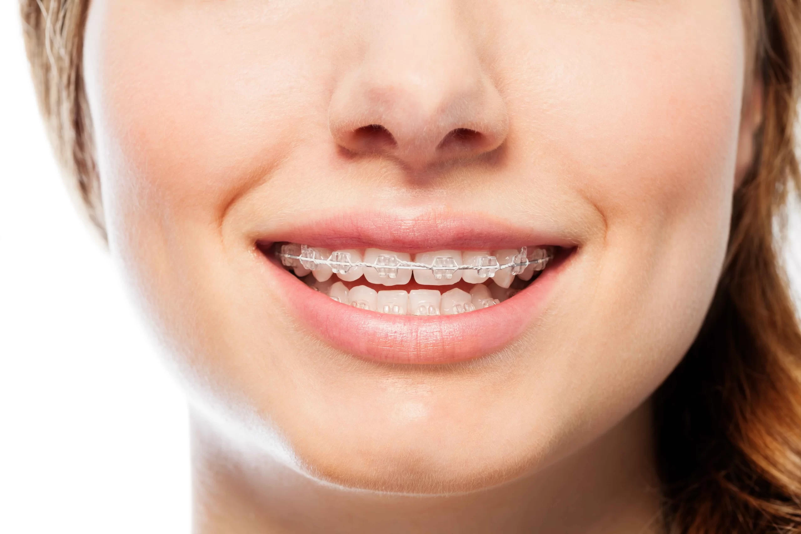 Close-up of smiles with clear braces results.