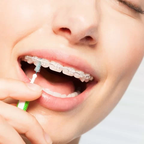 Girl cleaning her clear braces.