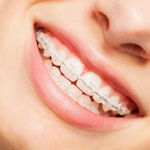 Close-up of a girl smiling with clear braces.