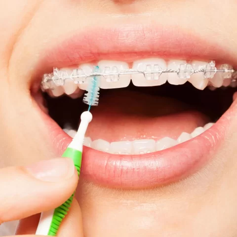 Cleaning clear braces for proper care and maintenance.