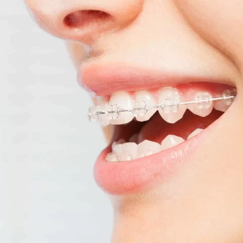 Side close-up of a girl with clear braces.