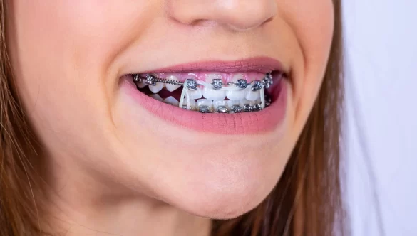 Can Braces Lead to Teeth Staining? What You Need to Know