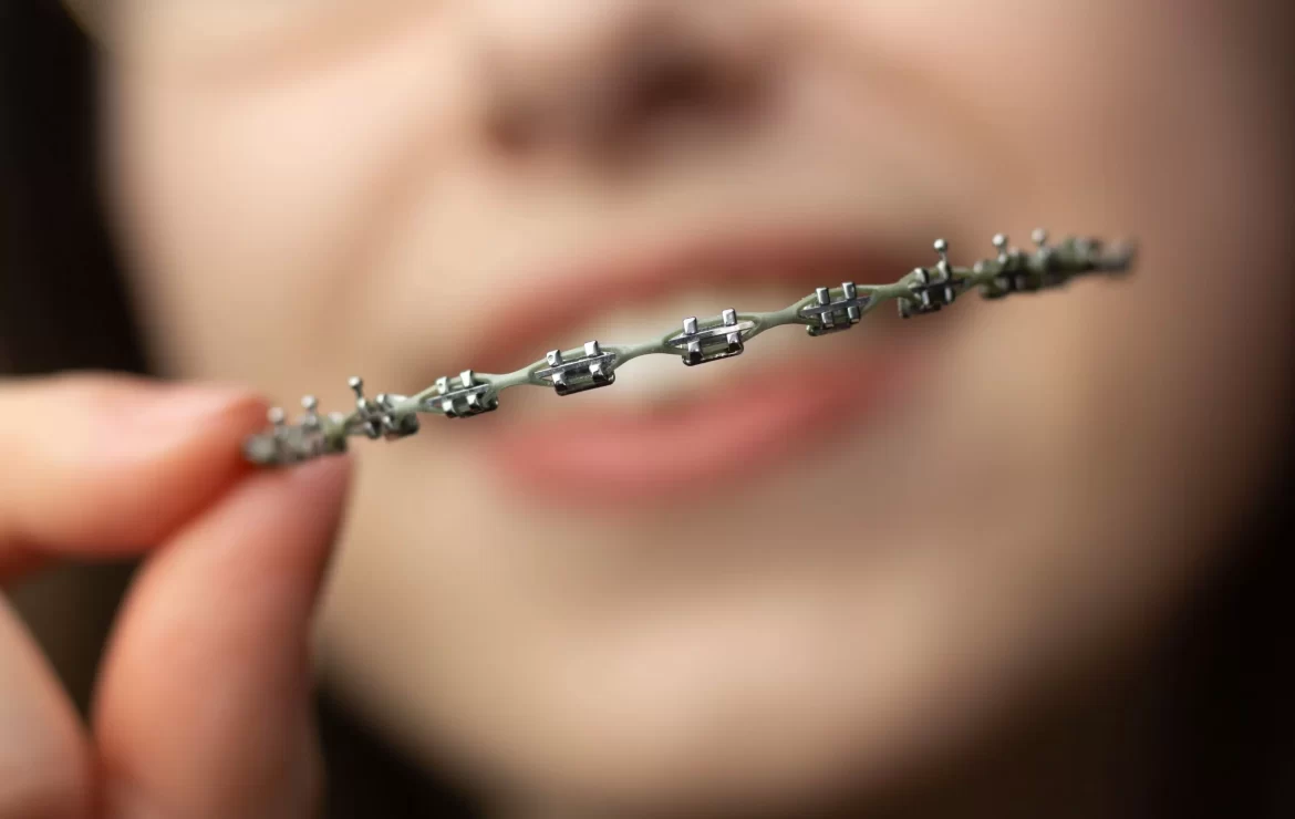 Understanding Braces Discomfort: What to Expect and How to Manage It