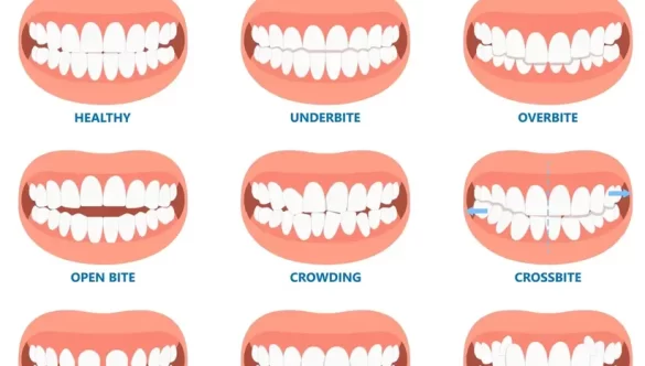 Understanding the Causes of Crooked Teeth and Malocclusions